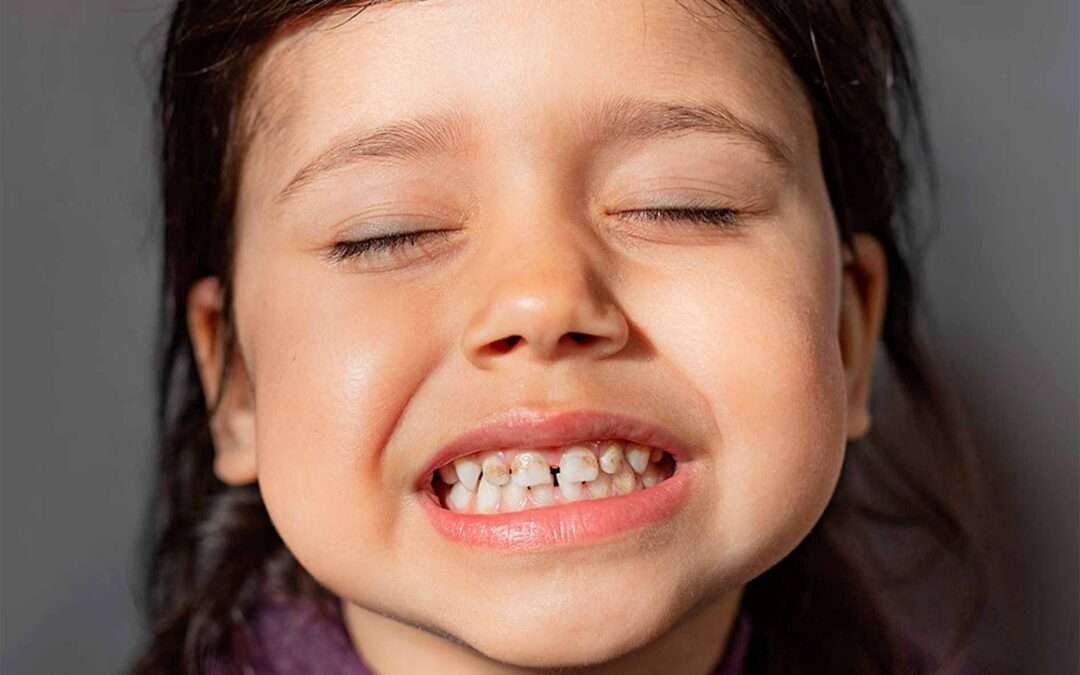Hipoplasia: ¿Manchas, porosidad o sensibilidad en los dientes de tu hijo?