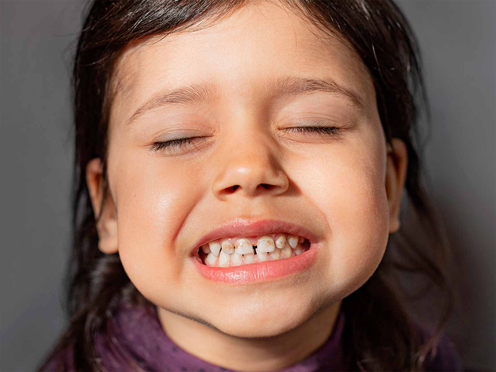 hipoplasia-dental-infantil